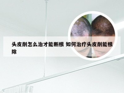 头皮削怎么治才能断根 如何治疗头皮削能根除