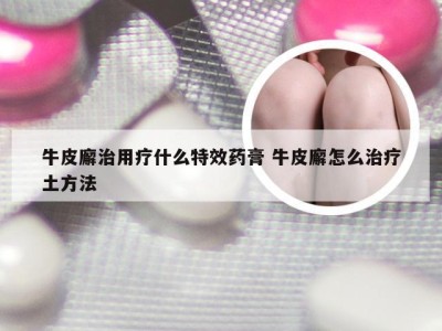 牛皮廨治用疗什么特效药膏 牛皮廨怎么治疗土方法