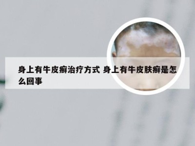 身上有牛皮癣治疗方式 身上有牛皮肤癣是怎么回事