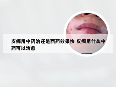 皮癣用中药治还是西药效果快 皮癣用什么中药可以治愈