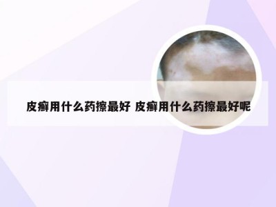 皮癣用什么药擦最好 皮癣用什么药擦最好呢