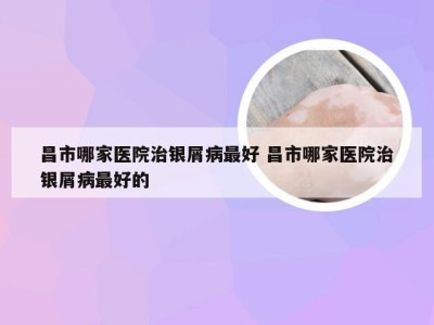 昌市哪家医院治银屑病最好 昌市哪家医院治银屑病最好的