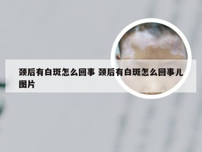 颈后有白斑怎么回事 颈后有白斑怎么回事儿图片