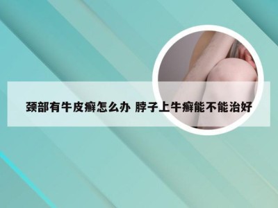 颈部有牛皮癣怎么办 脖子上牛癣能不能治好