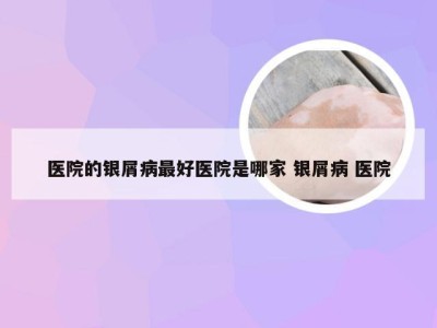 医院的银屑病最好医院是哪家 银屑病 医院