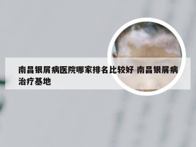 南昌银屑病医院哪家排名比较好 南昌银屑病治疗基地