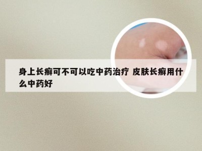 身上长癣可不可以吃中药治疗 皮肤长癣用什么中药好