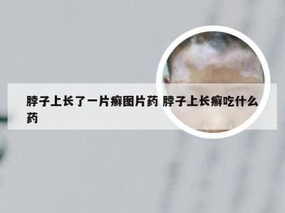 脖子上长了一片癣图片药 脖子上长癣吃什么药