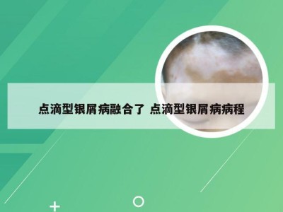 点滴型银屑病融合了 点滴型银屑病病程