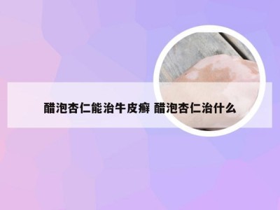 醋泡杏仁能治牛皮癣 醋泡杏仁治什么