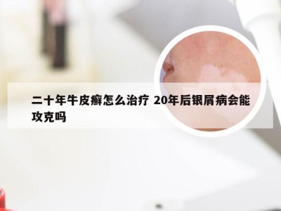 二十年牛皮癣怎么治疗 20年后银屑病会能攻克吗