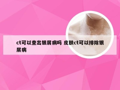 ct可以查出银屑病吗 皮肤ct可以排除银屑病