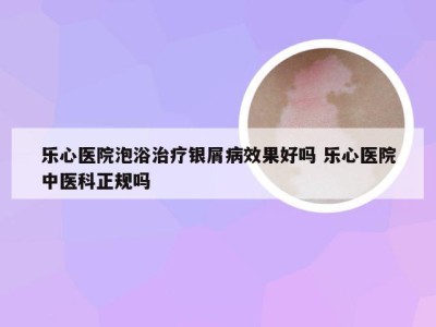 乐心医院泡浴治疗银屑病效果好吗 乐心医院中医科正规吗