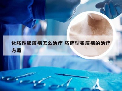 化脓性银屑病怎么治疗 脓疱型银屑病的治疗方案