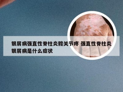 银屑病强直性脊柱炎髋关节疼 强直性脊柱炎银屑病是什么症状