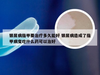 银屑病指甲要治疗多久能好 银屑病造成了指甲病变吃什么药可以治好