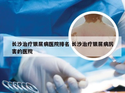 长沙治疗银屑病医院排名 长沙治疗银屑病厉害的医院