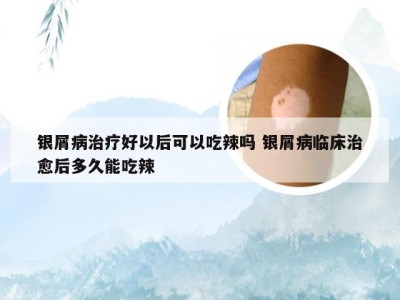 银屑病治疗好以后可以吃辣吗 银屑病临床治愈后多久能吃辣