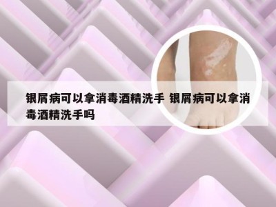 银屑病可以拿消毒酒精洗手 银屑病可以拿消毒酒精洗手吗