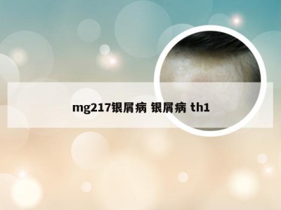 mg217银屑病 银屑病 th1