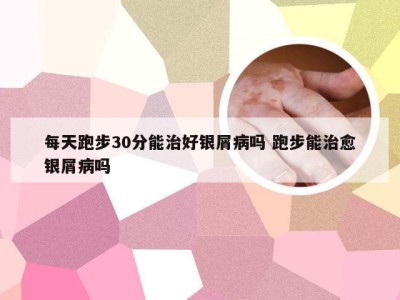 每天跑步30分能治好银屑病吗 跑步能治愈银屑病吗