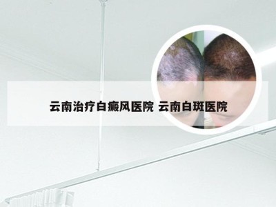 云南治疗白癜风医院 云南白斑医院