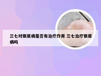 三七对银屑病是否有治疗作用 三七治疗银屑病吗