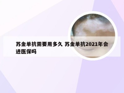 苏金单抗需要用多久 苏金单抗2021年会进医保吗