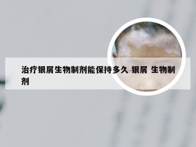 治疗银屑生物制剂能保持多久 银屑 生物制剂