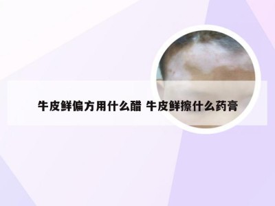 牛皮鲜偏方用什么醋 牛皮鲜擦什么药膏