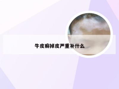 牛皮癣掉皮严重补什么