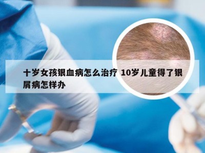 十岁女孩银血病怎么治疗 10岁儿童得了银屑病怎样办