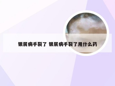 银屑病手裂了 银屑病手裂了用什么药