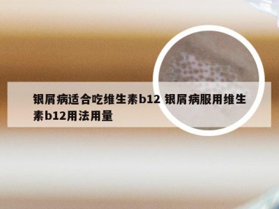 银屑病适合吃维生素b12 银屑病服用维生素b12用法用量