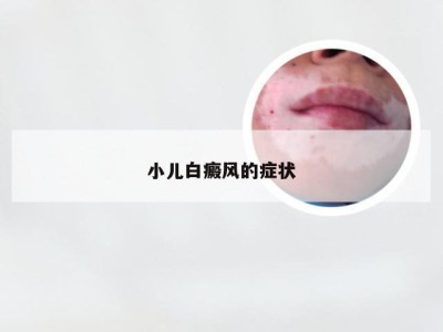 小儿白癜风的症状