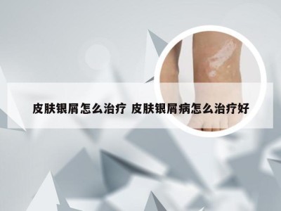 皮肤银屑怎么治疗 皮肤银屑病怎么治疗好