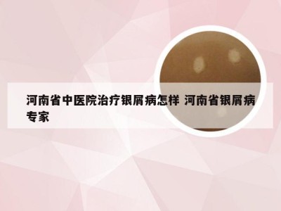 河南省中医院治疗银屑病怎样 河南省银屑病专家