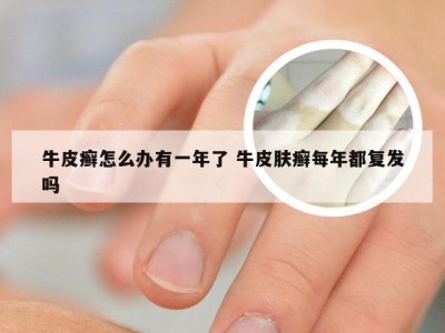 牛皮癣怎么办有一年了 牛皮肤癣每年都复发吗