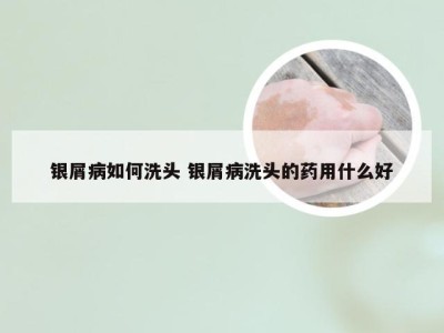 银屑病如何洗头 银屑病洗头的药用什么好