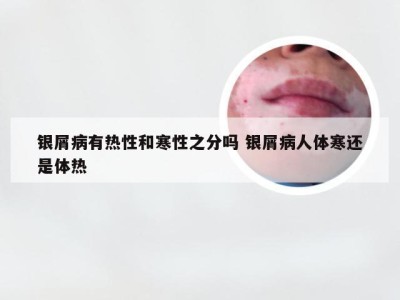 银屑病有热性和寒性之分吗 银屑病人体寒还是体热