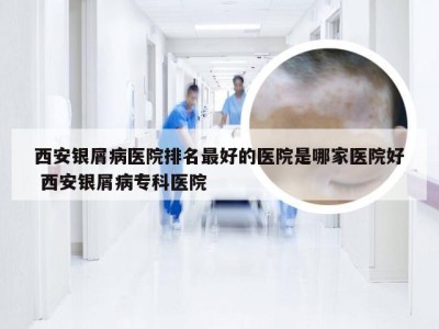 西安银屑病医院排名最好的医院是哪家医院好 西安银屑病专科医院