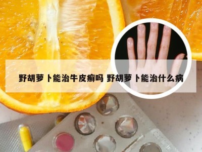 野胡萝卜能治牛皮癣吗 野胡萝卜能治什么病