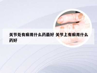 关节处有癣用什么药最好 关节上有癣用什么药好