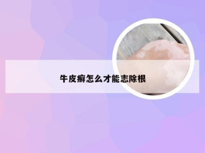 牛皮癣怎么才能志除根