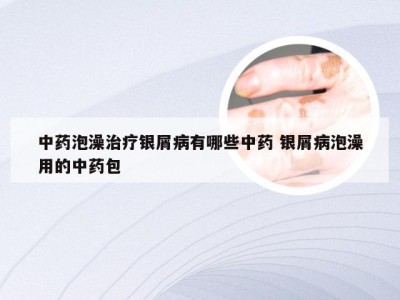 中药泡澡治疗银屑病有哪些中药 银屑病泡澡用的中药包