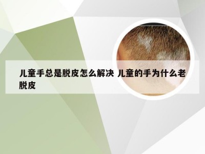 儿童手总是脱皮怎么解决 儿童的手为什么老脱皮