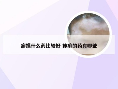 癣摸什么药比较好 抹癣的药有哪些