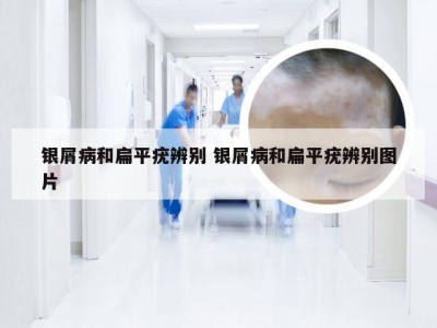 银屑病和扁平疣辨别 银屑病和扁平疣辨别图片