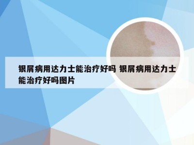 银屑病用达力士能治疗好吗 银屑病用达力士能治疗好吗图片