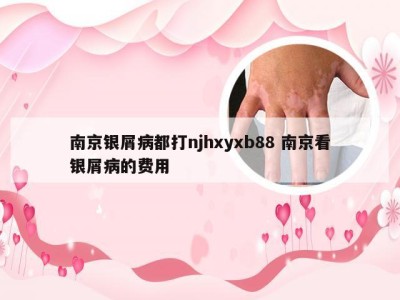 南京银屑病都打njhxyxb88 南京看银屑病的费用